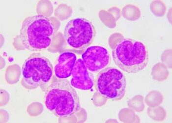 9 de cada 10 pacientes con leucemia linfocítica crónica no reconocen los síntomas antes del diagnóstico