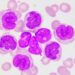9 de cada 10 pacientes con leucemia linfocítica crónica no reconocen los síntomas antes del diagnóstico